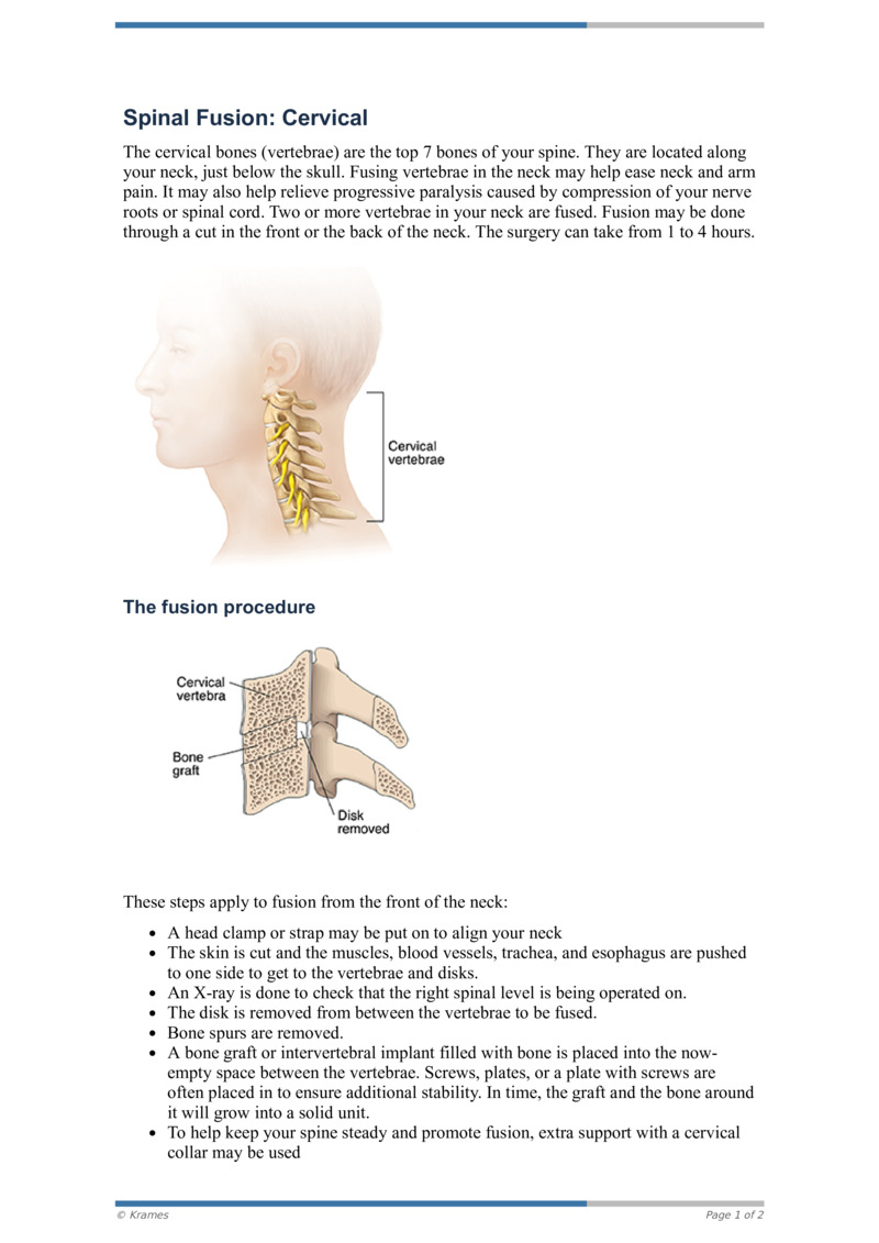 Pdf Spinal Fusion Cervical Healthclips Online