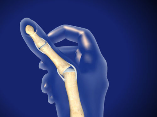 Video Thumb Ulnar Collateral Ligament UCL Injury HealthClips Online