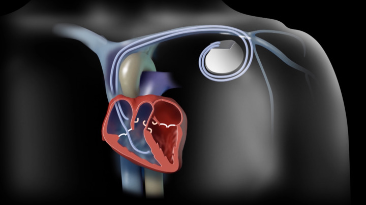 Video - The Need for a Pacemaker - HealthClips Online