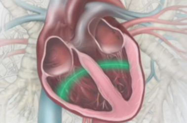 Thumbnail image for "The Need for a Pacemaker"