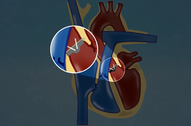 Thumbnail image for "Understanding Heart Valve Surgery"