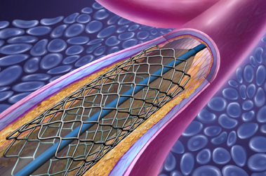 Thumbnail image for "What is a Heart Stent?"