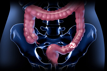 Thumbnail image for "Colorectal Cancer"