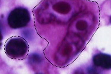 Thumbnail image for "Lymphoma"
