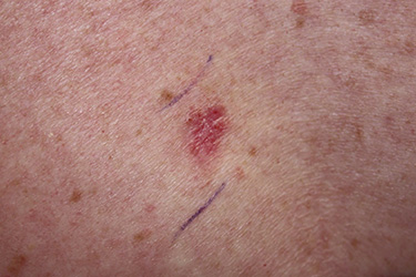 Thumbnail image for "Skin Cancer"
