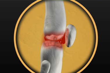 Thumbnail image for "What is Osteoarthritis?"