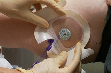 Thumbnail image for "Changing Your PICC Line Dressings"