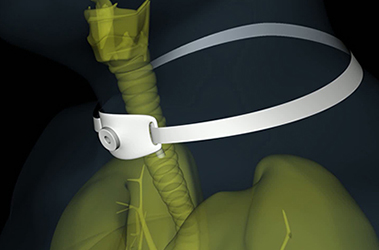 Thumbnail image for "What is a Tracheostomy?"