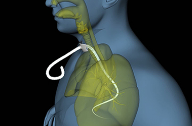 Thumbnail image for "Tracheostomy: How to Avoid Mucus Build-up"