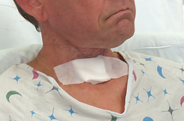 Thumbnail image for "Having Your Tracheostomy Removed"
