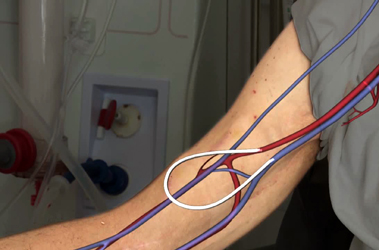 Thumbnail image for "What is an Arteriovenous Graft for Hemodialysis?"