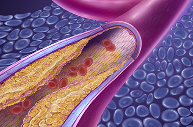 Thumbnail image for "Angiografía Coronarias y Angioplastia"