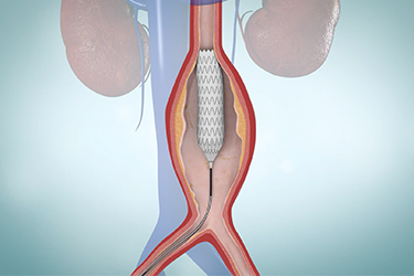 Thumbnail image for "Aneurisma aórtico abdominal: reparación endovascular"