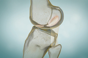 Thumbnail image for "ACL Injuries"