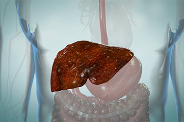 Thumbnail image for "Hepatitis Alcohólica"