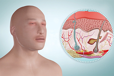 Thumbnail image for "Reacción alérgica: Angioedema"