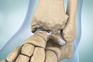Thumbnail image for "Ankle Arthritis and Replacement"