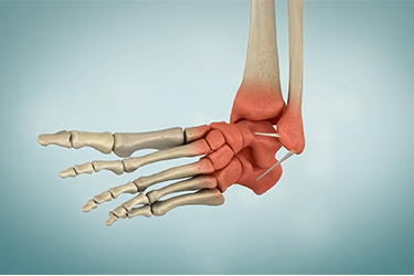 Thumbnail image for "Ankle Sprain"