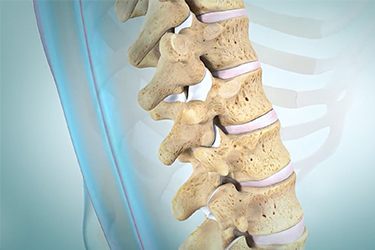 Thumbnail image for "Artritis de la columna vertebral"