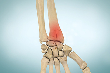 Thumbnail image for "Broken Wrist (Wrist Fracture)"