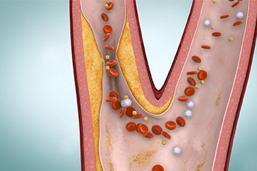 Thumbnail image for "Carotid Artery Disease"