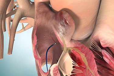Thumbnail image for "Catheter Ablation for Arrhythmia"