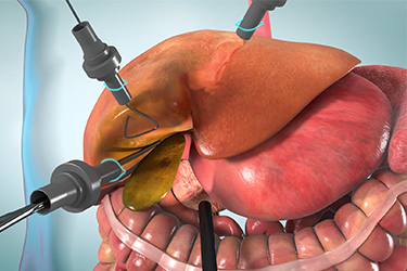 Thumbnail image for "Cirugía de vesícula (colecistectomía)"