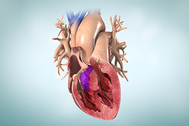 Thumbnail image for "Heart Murmurs in Children"
