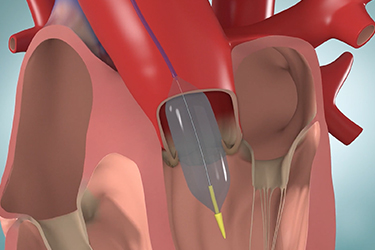 Thumbnail image for "Cirugía de reparación o reemplazo de válvula cardíaca: percutánea"