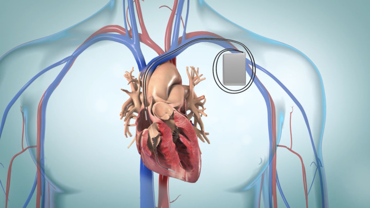 Video - ICD: Implantable Cardioverter Defibrillator - HealthClips Online