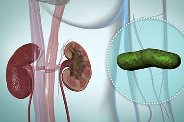 Thumbnail image for "Kidney Infection (Pyelonephritis)"