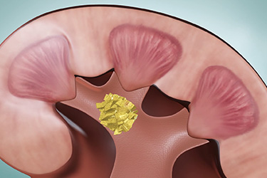Thumbnail image for "Kidney Stones"