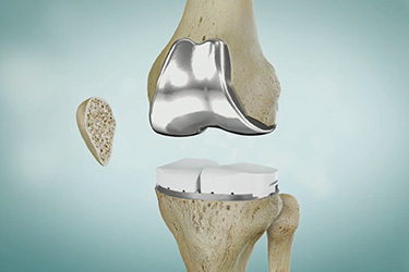 Thumbnail image for "Artritis de rodilla y reemplazo de rodilla fija"