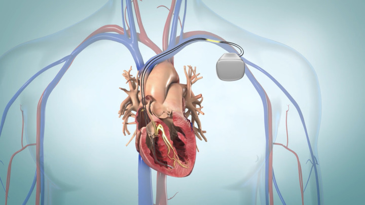 Video - Pacemakers - HealthClips Online