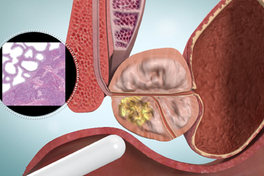 Thumbnail image for "Prostate Cancer Treatment: Grading and Staging"