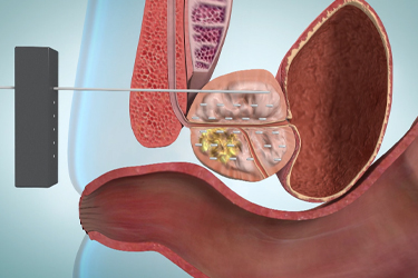Thumbnail image for "Tratamiento del cáncer de próstata: sus opciones"