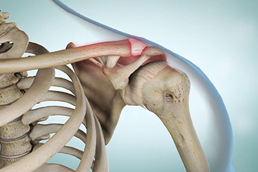 Thumbnail image for "Shoulder (AC) Arthritis"
