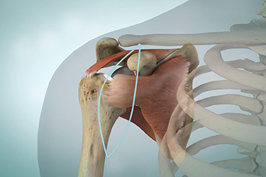 Thumbnail image for "Shoulder Arthritis and Replacement"