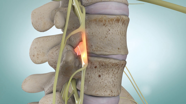 Video - Spinal Stenosis - HealthClips Online