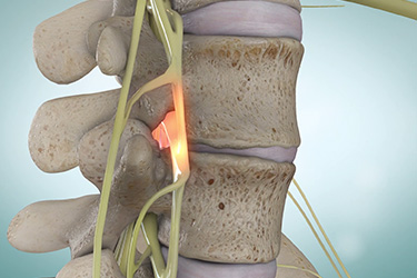 Thumbnail image for "Spinal Stenosis"