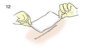 Thumbnail image for "Step-by-Step: Changing a Surgical Wound Dressing"