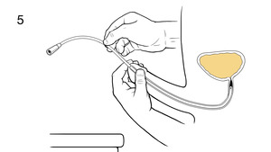 Thumbnail image for "Step-by-Step: Inserting a Disposable Catheter (Man)"