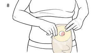 Thumbnail image for "Step-by-Step: Stoma Care: Changing the Pouch"