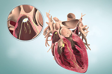 Thumbnail image for "Supraventricular Tachycardia: Types"