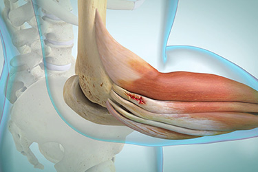 Thumbnail image for "Epicondilitis lateral"