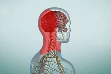 Thumbnail image for "Tension-Type Headache"