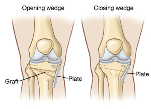 Knee Osteotomy アップデート ゼロからはじめる!Knee Osteotomyアップデート Osteotomy
