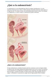Thumbnail image for "¿Qué es la endometriosis?"