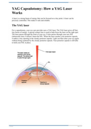 Thumbnail image for "YAG Capsulotomy: How a YAG Laser Works"