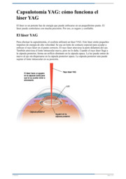 Thumbnail image for "Capsulotomía YAG: cómo funciona el láser YAG"
